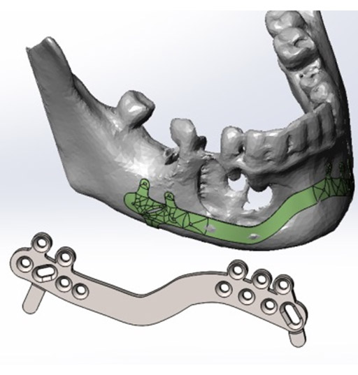 Индивидуальный имплант для реконструкции нижней челюсти