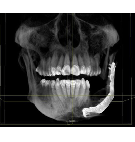 Индивидуальный имплант для реконструкции нижней челюсти