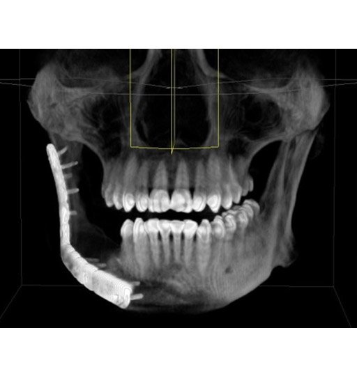 Индивидуальный имплант для реконструкции нижней челюсти