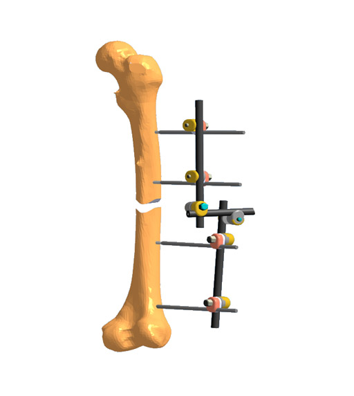 Аппарат стержневой внешней фиксации переломов длинных трубчатых костей