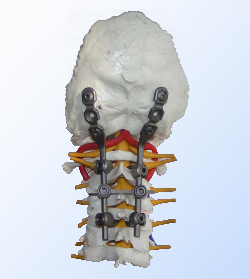 Титановая конструкция для окципитоспондилодеза Тип 1